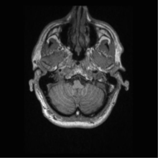 File:Alzheimer disease - probable (Radiopaedia 35334-36837 Axial T1 15).png