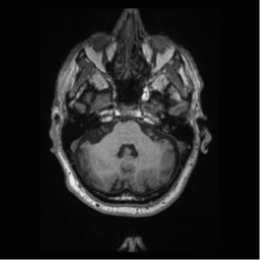 Alzheimer disease - probable (Radiopaedia 35334-36837 Axial T1 21).png