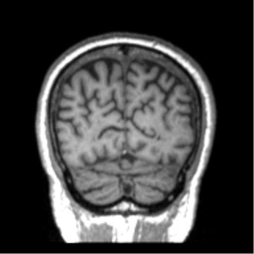 Alzheimer disease and cerebral amyloid angiopathy (Radiopaedia 64234-73011 Coronal T1 3).png