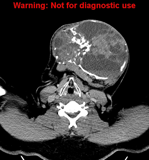 File:Ameloblastoma (Radiopaedia 33126-34164 B 23).jpg