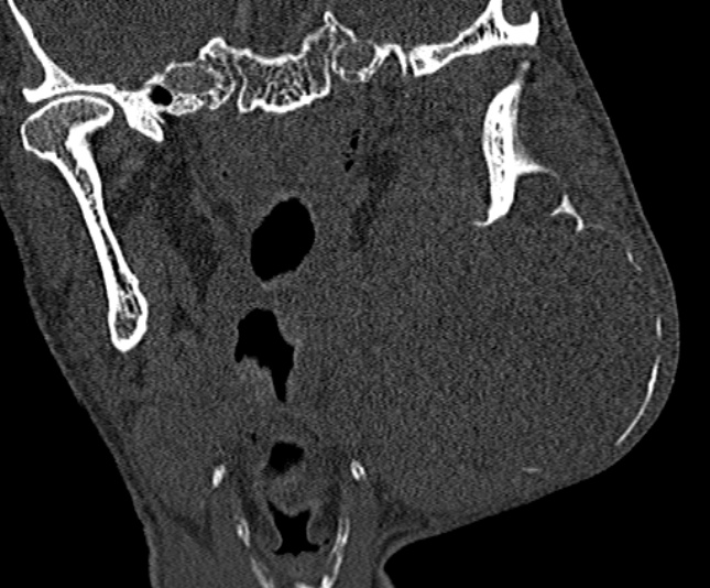 Ameloblastoma (Radiopaedia 51921-57766 Coronal bone window 171).jpg