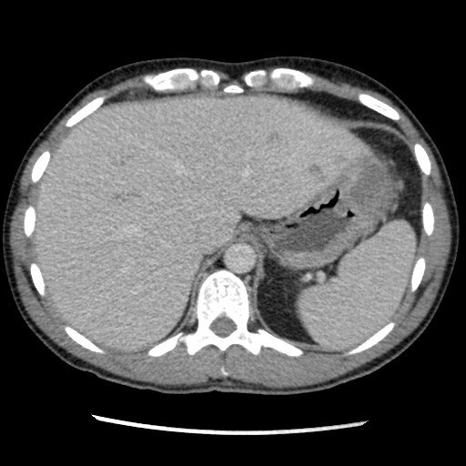 Amoebic liver abscesses (Radiopaedia 55536-62009 A 19).jpg