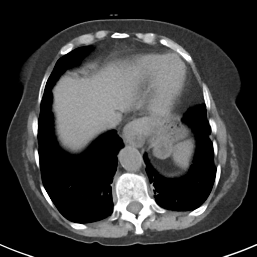 File:Ampullary adenocarcinoma (Radiopaedia 34013-35237 Axial non-contrast 6).png