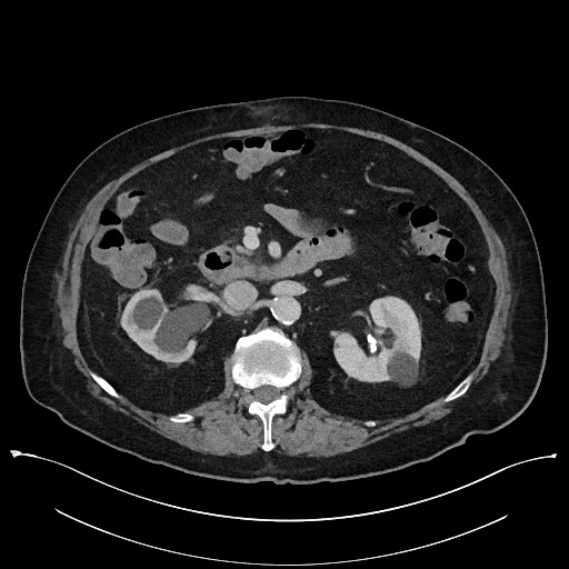 Ampullary adenocarcinoma (Radiopaedia 59373-66737 A 69).jpg