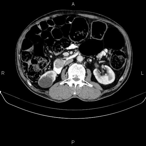 Ampullary adenocarcinoma (Radiopaedia 86093-102032 A 28).jpg