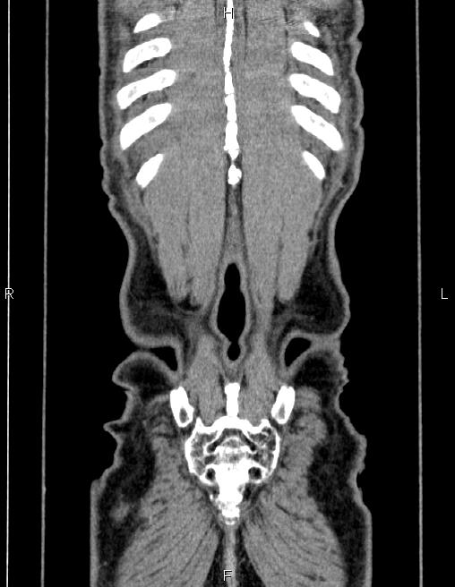 Ampullary adenocarcinoma (Radiopaedia 86093-102032 C 65).jpg
