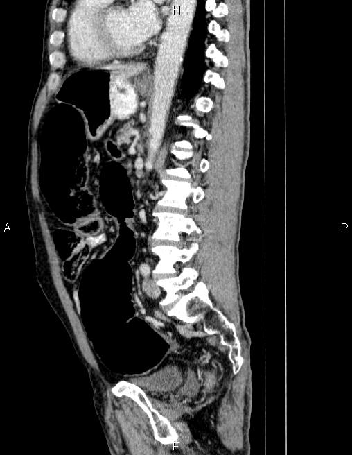 Ampullary adenocarcinoma (Radiopaedia 86093-102032 D 58).jpg