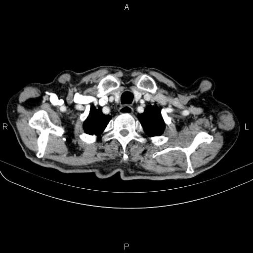 Ampullary adenocarcinoma (Radiopaedia 86093-102033 B 14).jpg