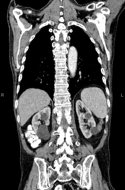 Ampullary adenocarcinoma (Radiopaedia 86093-102033 D 46).jpg
