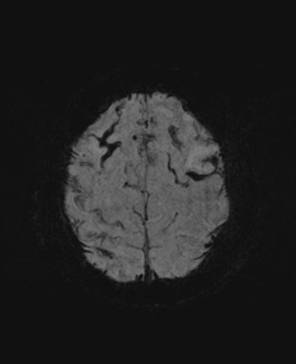 File:Amyloid angiopathy with inflammation (Radiopaedia 30360-31002 Axial SWI MIP 53).jpg