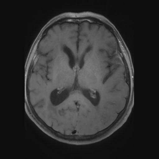 File:Amyloid angiopathy with inflammation (Radiopaedia 30360-31002 Axial T1 C+ fat sat 17).jpg