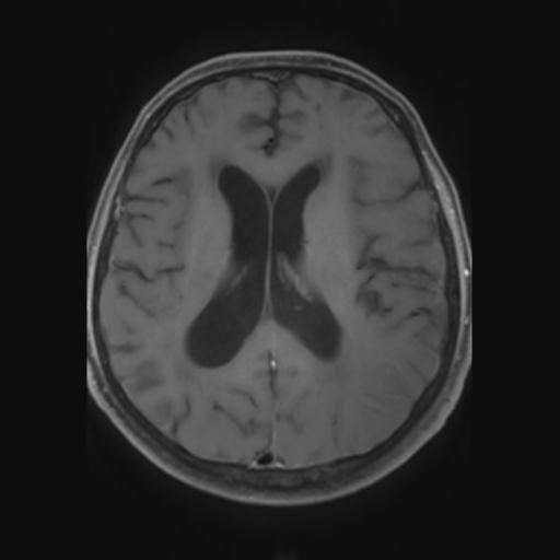 File:Amyloid angiopathy with inflammation (Radiopaedia 30360-31002 Axial T1 C+ fat sat 19).jpg