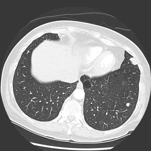 File:Amyloidosis - bronchial and diffuse nodular pulmonary involvement (Radiopaedia 60156-67745 Axial lung window 67).jpg