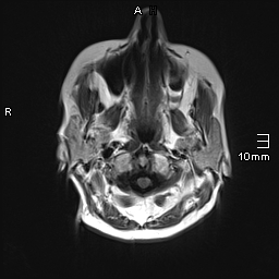 File:Amyotrophic lateral sclerosis (Radiopaedia 70821-81017 Axial T1 2).jpg