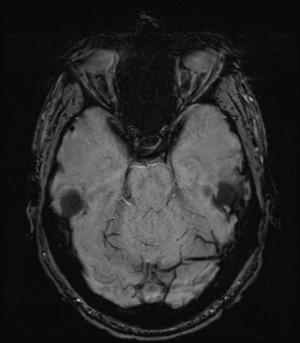 Amyotrophic lateral sclerosis (Radiopaedia 87352-103658 Axial SWI 16).jpg