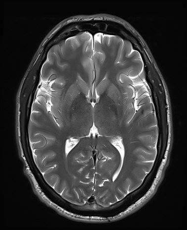 File:Amyotrophic lateral sclerosis (Radiopaedia 87352-103658 Axial T2 14).jpg