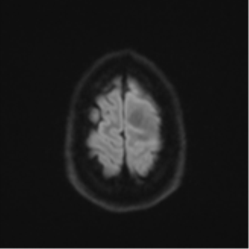 Anaplastic astrocytoma (Radiopaedia 57768-64731 Axial DWI 54).png