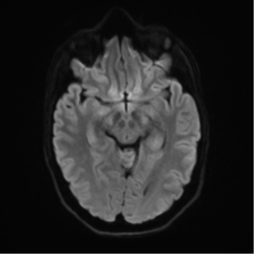 Anaplastic astrocytoma IDH mutant (Radiopaedia 50046-55341 Axial DWI 39).png