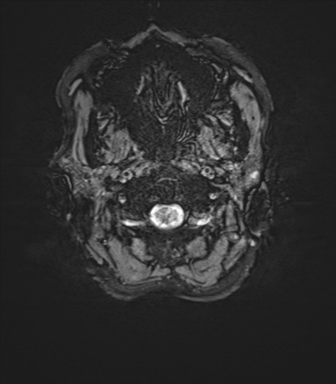 File:Anaplastic astrocytoma IDH mutant (Radiopaedia 50046-55341 Axial SWI 1).png
