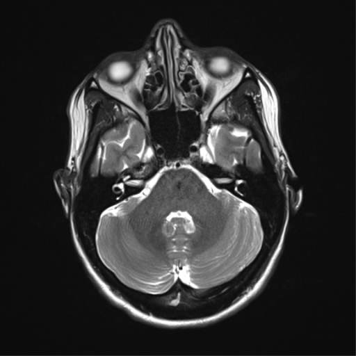 File:Anaplastic astrocytoma IDH mutant (Radiopaedia 50046-55341 Axial T2 11).png