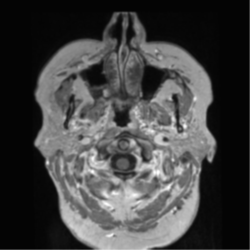 File:Anaplastic astrocytoma IDH wild-type (pseudoprogression) (Radiopaedia 42209-45278 Axial T1 C+ 17).png