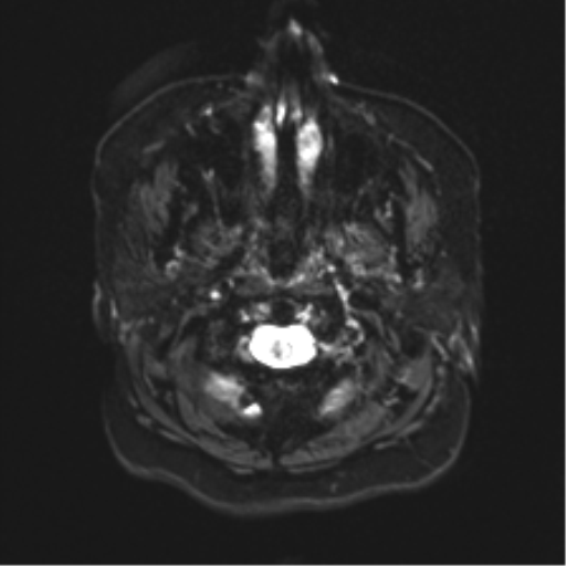File:Anaplastic astrocytoma IDH wild-type (pseudoprogression) (Radiopaedia 42209-45279 Axial DWI 1).png