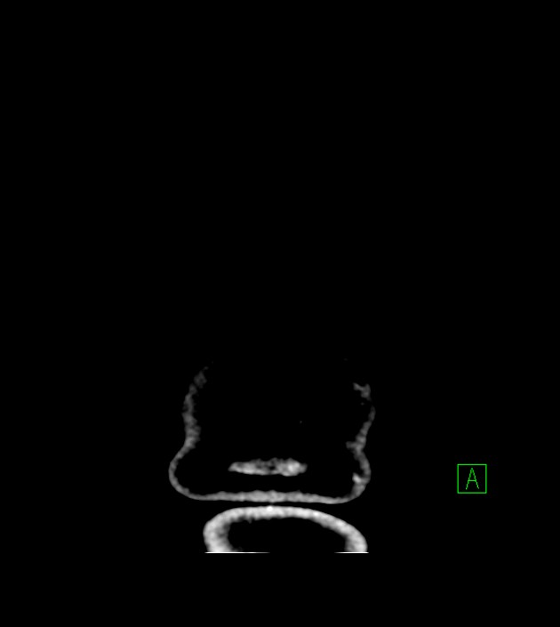 Anaplastic oligodendroglioma (Radiopaedia 79571-92758 Coronal non-contrast 69).jpg