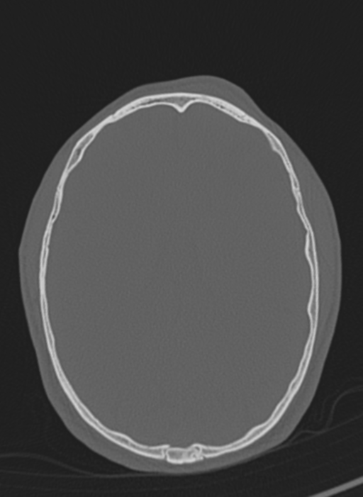 Anaplastic oligodendroglioma with skull fracture (Radiopaedia 74831-85846 Axial bone window 23).png