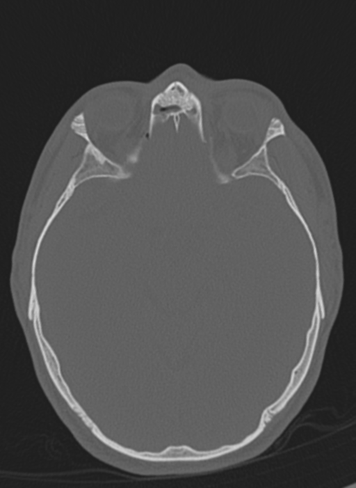 Anaplastic oligodendroglioma with skull fracture (Radiopaedia 74831-85846 Axial bone window 43).png