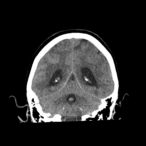 Aneursym related subarachnoid hemorrhage with hydrocephalus (Radiopaedia 45105-49083 Coronal non-contrast 45).jpg