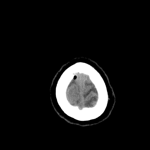 Aneursym related subarachnoid hemorrhage with hydrocephalus (Radiopaedia 45105-49085 Axial non-contrast 49).jpg