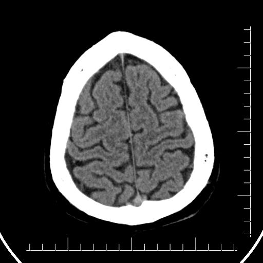 Aneurysm of posterior communicating artery (Radiopaedia 20188-20162 Axial non-contrast 41).jpg