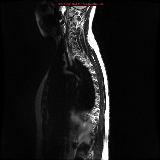 File:Aneurysmal bone cyst (Radiopaedia 9419-10103 G 11).jpg