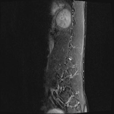 File:Aneurysmal bone cyst T11 (Radiopaedia 29294-29720 Sagittal STIR 1).jpg