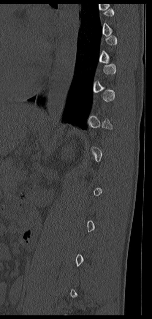Aneurysmal bone cyst T11 (Radiopaedia 29294-29721 Sagittal bone window 21).jpg