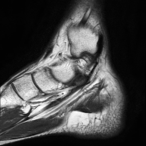 File:Aneurysmal bone cyst of the calcaneus (Radiopaedia 60669-68420 Sagittal T1 18).jpg