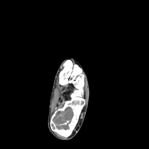 File:Aneurysmal bone cyst of the calcaneus (Radiopaedia 60669-68421 A 28).jpg