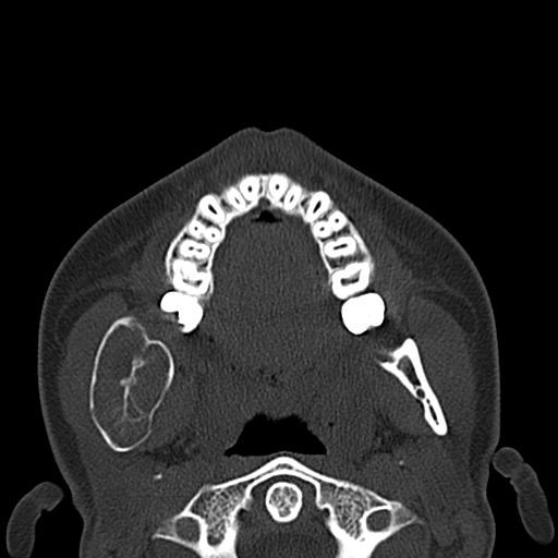 File:Aneurysmal bone cyst of the mandible (Radiopaedia 43280-46601 Axial bone window 44).jpg