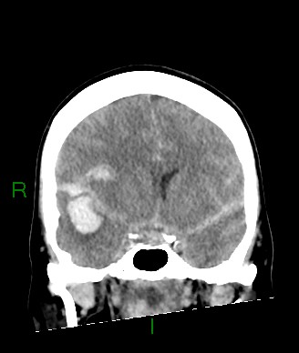 Aneurysmal subarachnoid hemorrhage with intra-axial extension (Radiopaedia 84371-99699 Coronal non-contrast 42).jpg