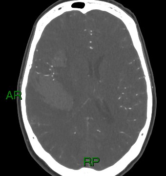 File:Aneurysmal subarachnoid hemorrhage with intra-axial extension (Radiopaedia 84371-99732 A 16).jpg