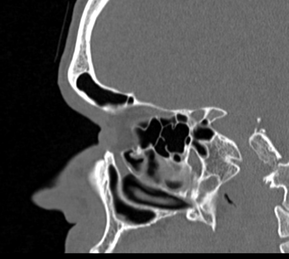 Angular epidermoid cyst (Radiopaedia 46908-51439 Sagittal bone window 57).png