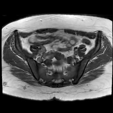 File:Ano-vaginal fistula (Radiopaedia 29765-30284 Axial T1 25).jpg