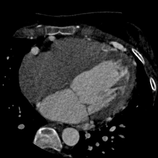 File:Anomalous left coronary artery from the pulmonary artery (ALCAPA) (Radiopaedia 40884-43586 A 47).jpg