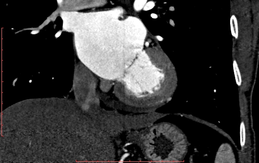 Anomalous left coronary artery from the pulmonary artery (ALCAPA) (Radiopaedia 70148-80181 B 187).jpg