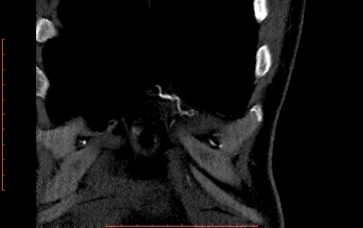 Anomalous left coronary artery from the pulmonary artery (ALCAPA) (Radiopaedia 70148-80181 B 33).jpg