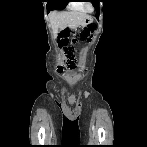 Anorectal carcinoma (Radiopaedia 44413-48064 B 1).jpg