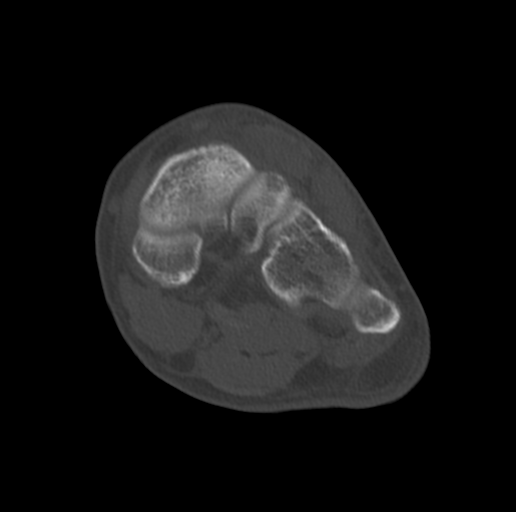 Anterior calcaneal process fracture (Radiopaedia 47384-51989 Coronal bone window 46).png