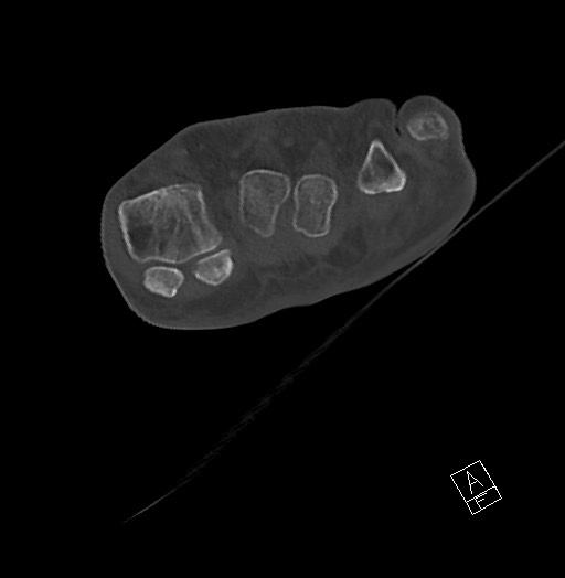 Anterior calcaneal process fracture (Radiopaedia 63353-71943 Axial bone window 43).jpg