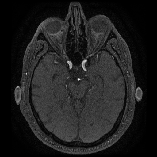 Anterior cerebral artery infarction (Radiopaedia 46794-51323 Axial MRA 73).jpg