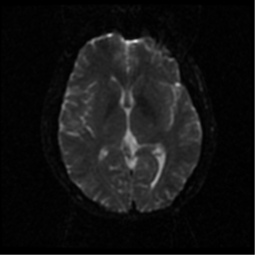 File:Anterior cerebral artery territory infarct (Radiopaedia 39327-41584 Axial DWI 38).png